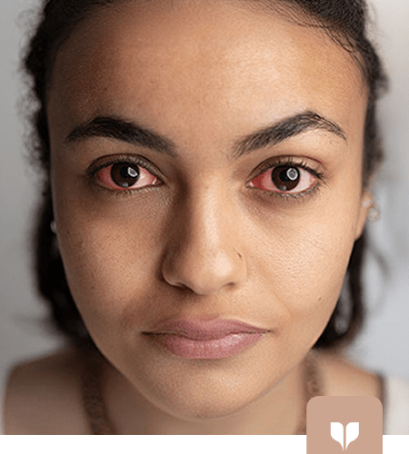 Eye disease